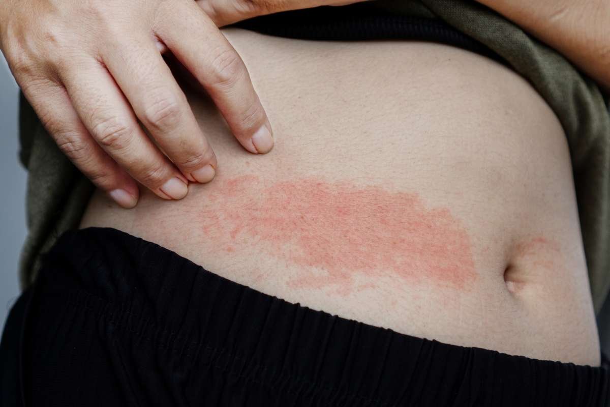 Skin Rashes: Powerful Causes and Proven Soothing Fixes | The Lifesciences Magazine