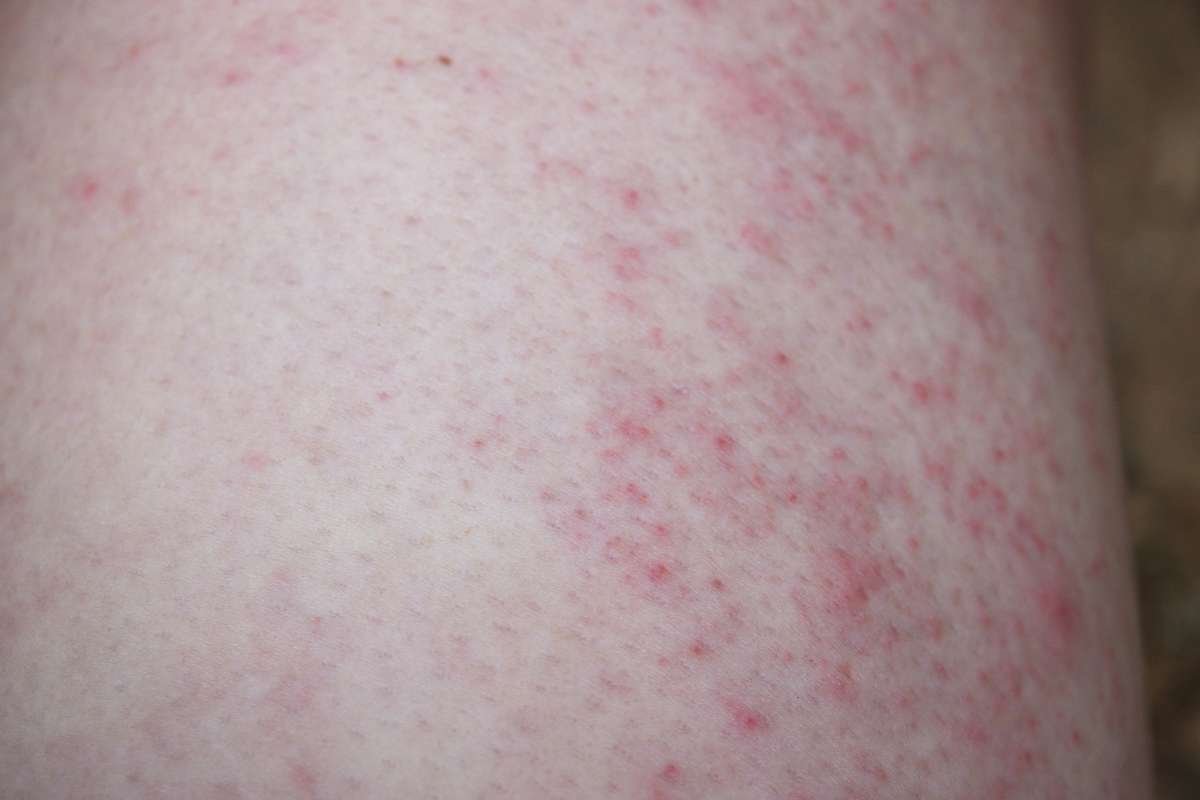 Skin Rashes: Powerful Causes and Proven Soothing Fixes | The Lifesciences Magazine