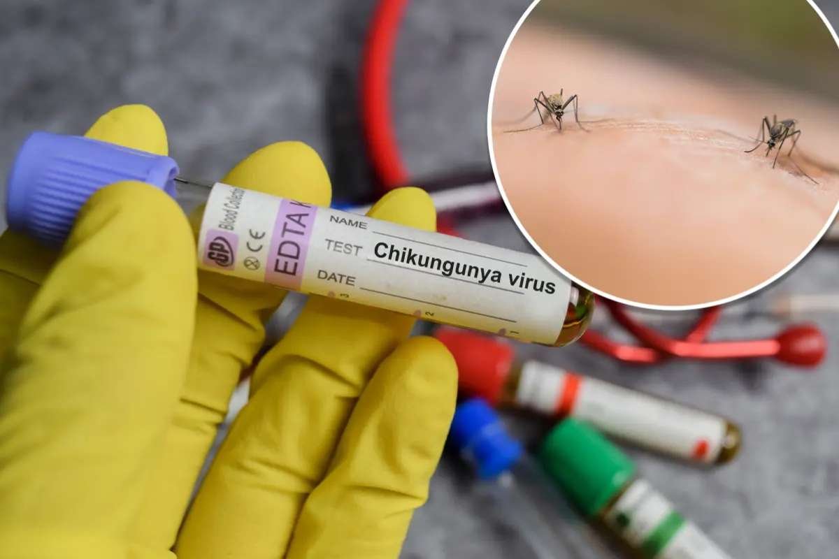 New York Confirms First Local Chikungunya Virus Case in Six Years | The Lifesciences Magazine