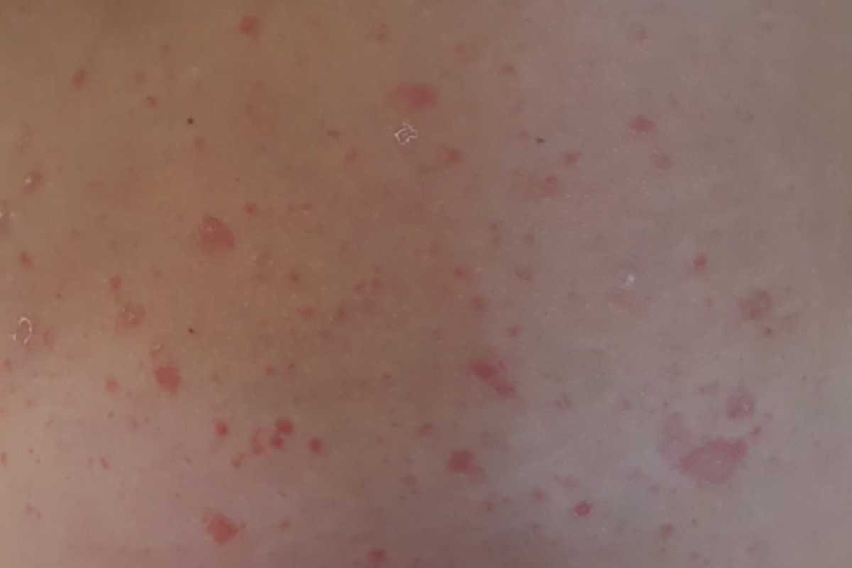 Types of Skin Rashes: Hormonal, Allergic & Infectious Signs | The Lifesciences Magazine