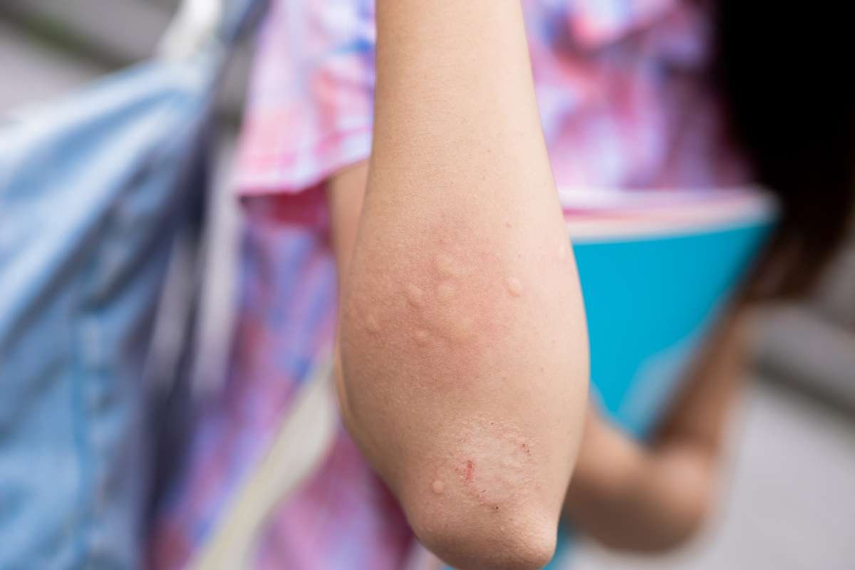 Why Mosquito Bites Itch: The Science behind the Irritation | The Lifesciences Magazine