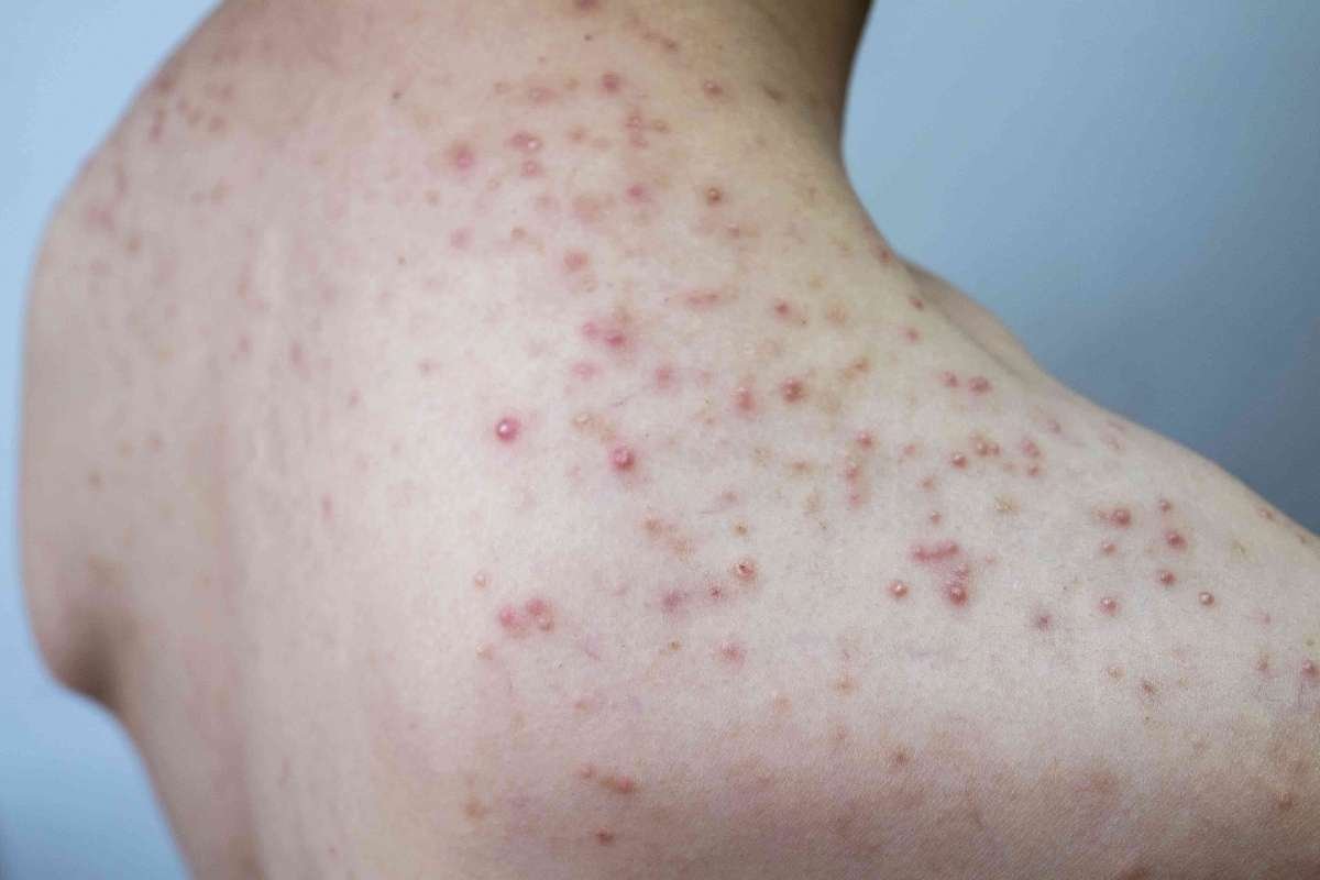 Types of Skin Rash Diseases: Causes, Symptoms, and Common Conditions | The Lifesciences Magazine