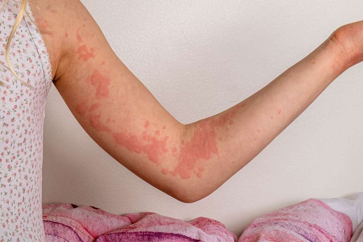 Types of Skin Rash Diseases: Causes, Symptoms, and Common Conditions | The Lifesciences Magazine