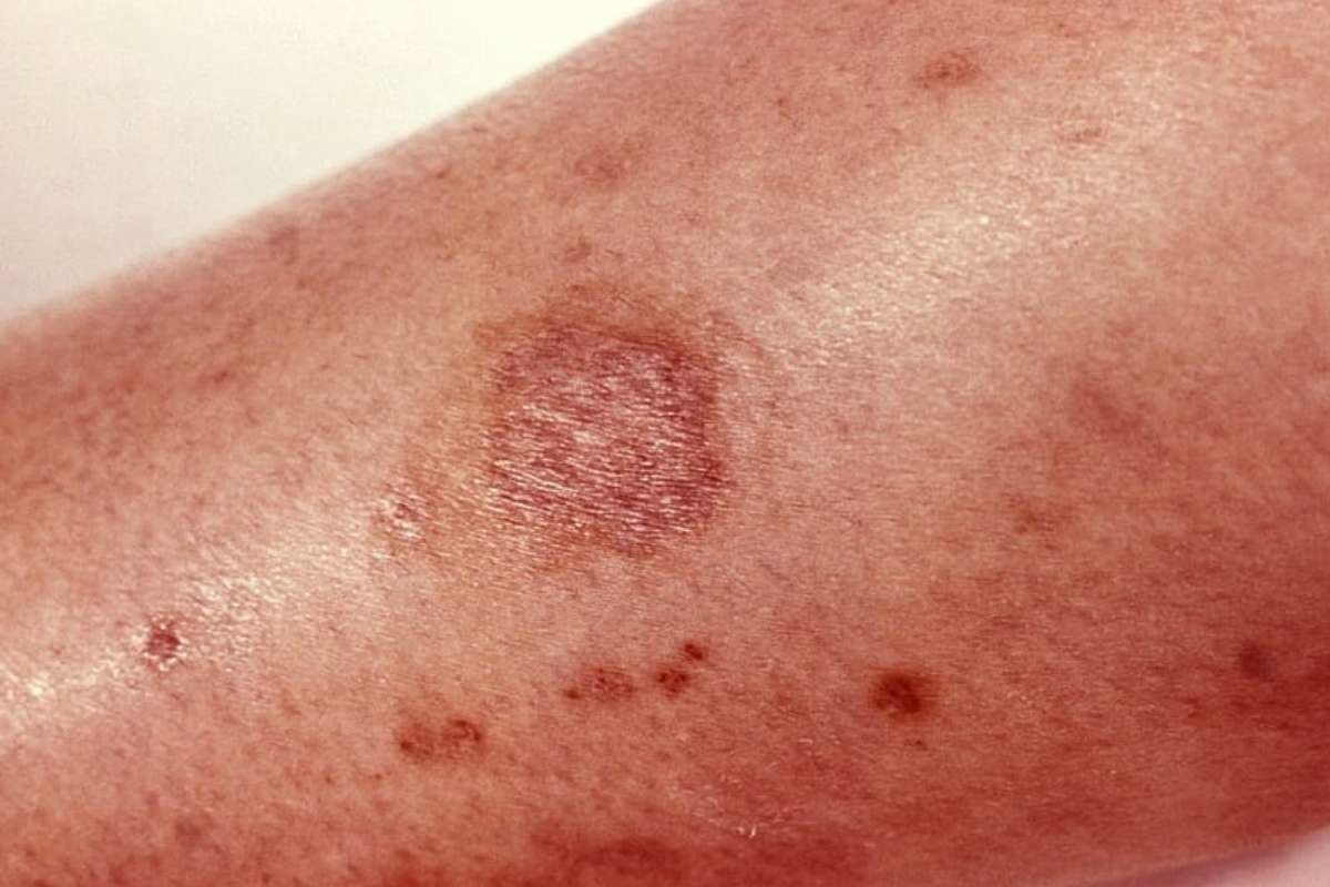 Spider Bites Pictures & Treatments: Identify Dangerous Bites | The Lifesciences Magazine