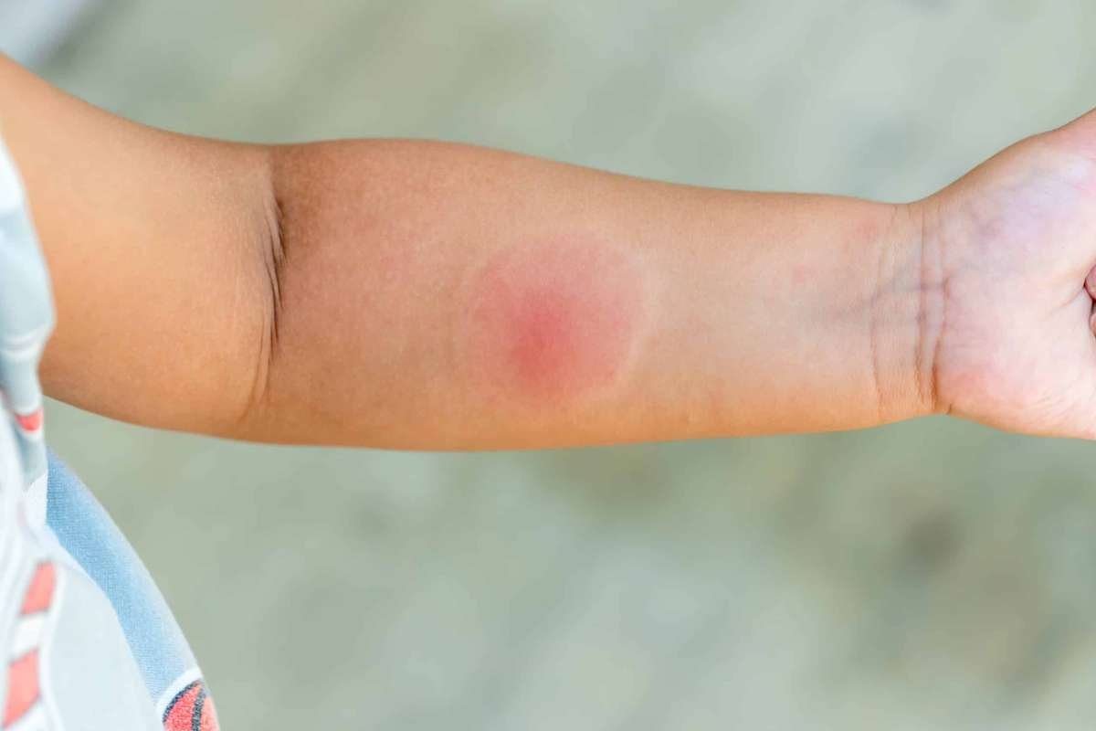 Spider Bites Pictures & Treatments: Identify Dangerous Bites | The Lifesciences Magazine