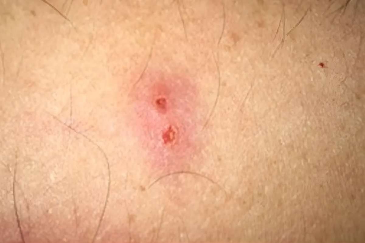 Spider Bites Pictures & Treatments: Identify Dangerous Bites | The Lifesciences Magazine