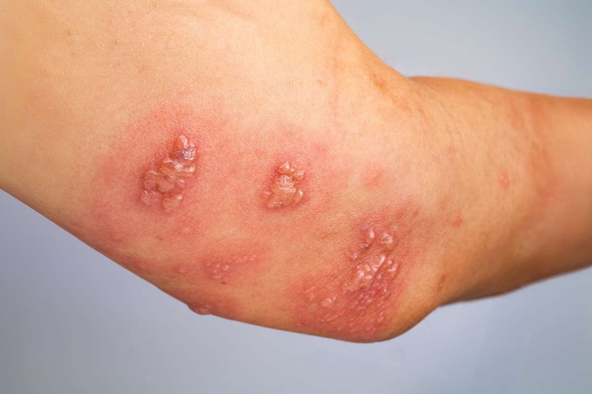 Spider Bites Pictures & Treatments: Identify Dangerous Bites | The Lifesciences Magazine