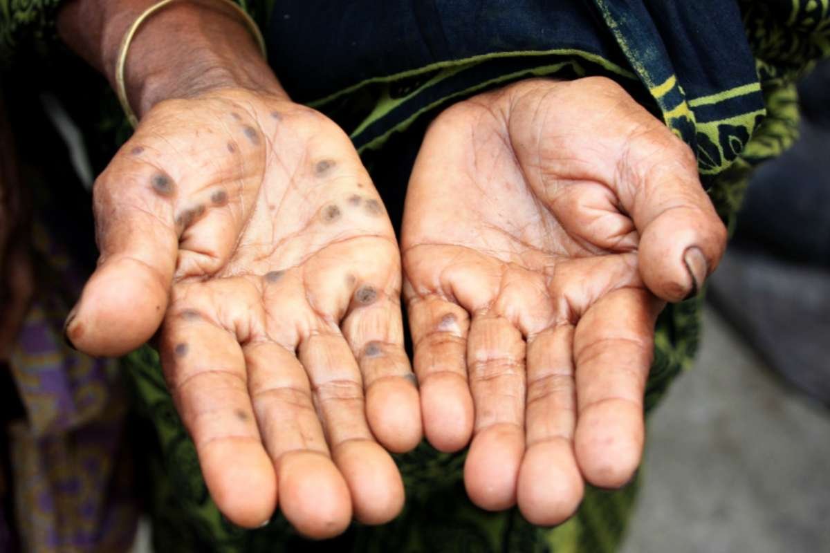 The Truth About Arsenic Poisoning Your Body Never Warns You About | The Lifesciences Magazine