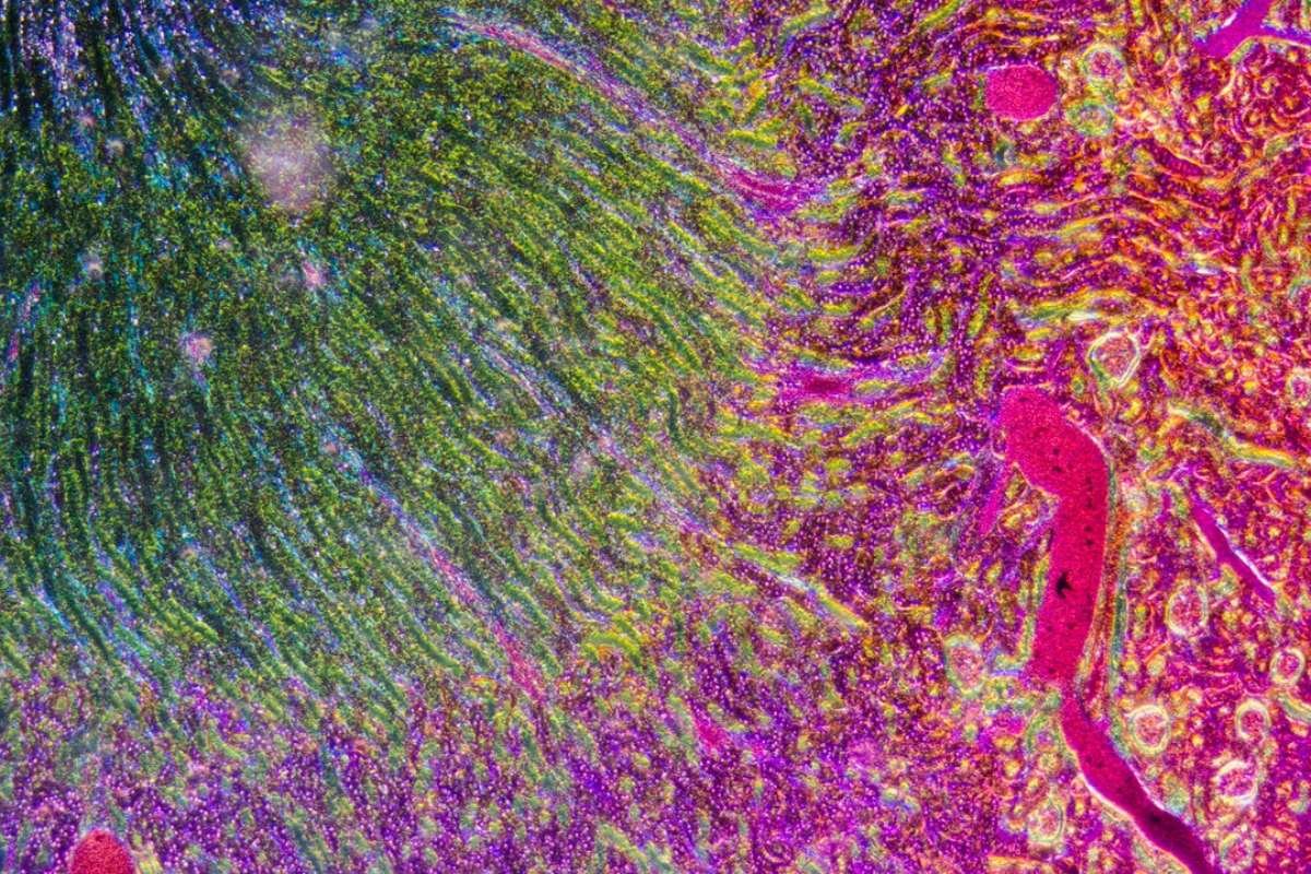 AI Cancer Tools Shortcut Learning, Warwick Study Warns | The Lifesciences Magazine