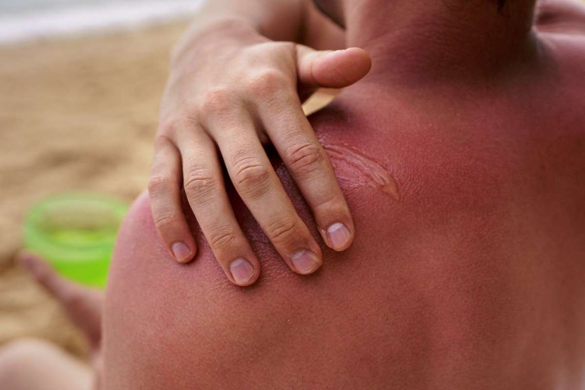 RNA Damage Sunburn Discovery Challenges Decades in Skin Science | The Lifesciences Magazine
