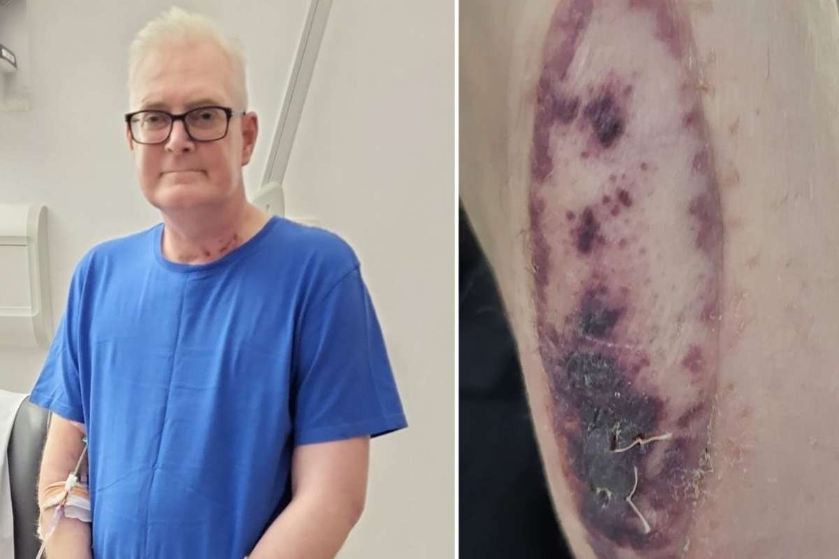 Skin Graft Helps Detect Lung Transplant Rejection Early in UK | The Lifesciences Magazine