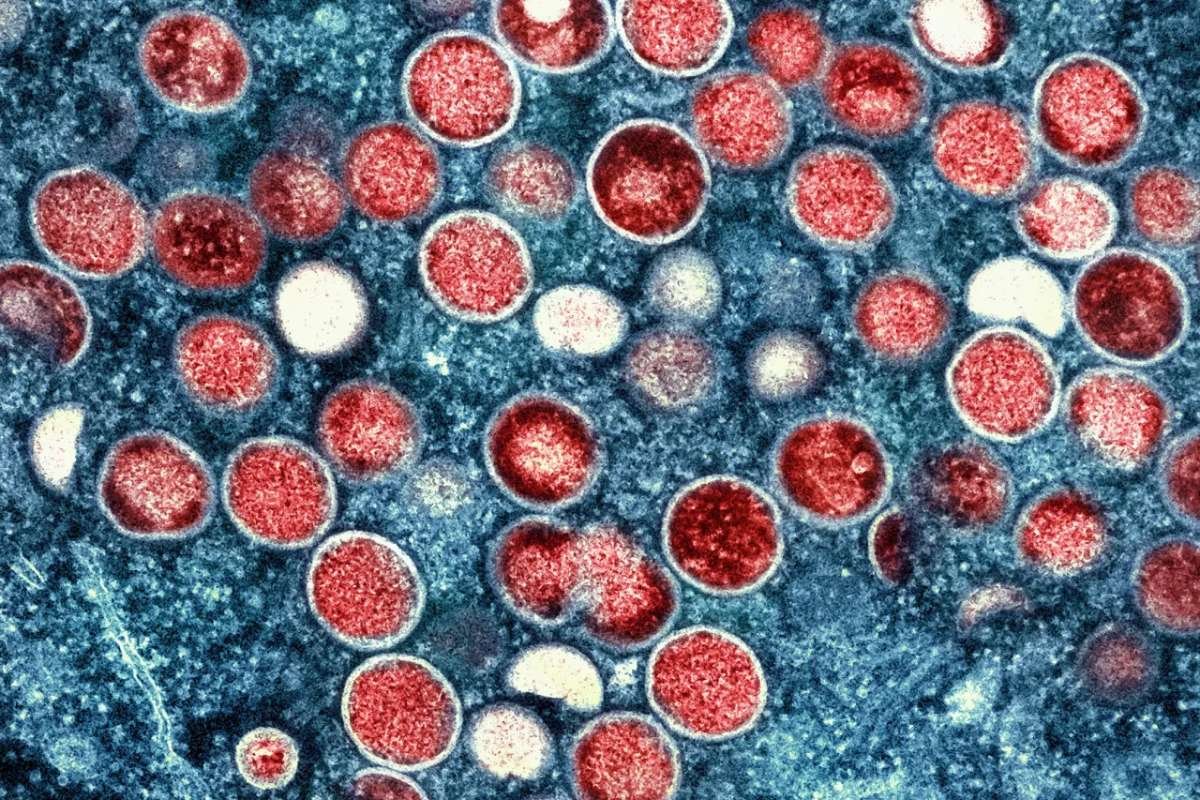 Wisconsin Reports First Mpox Cases of 2026 Amid US Rise | The Lifesciences Magazine