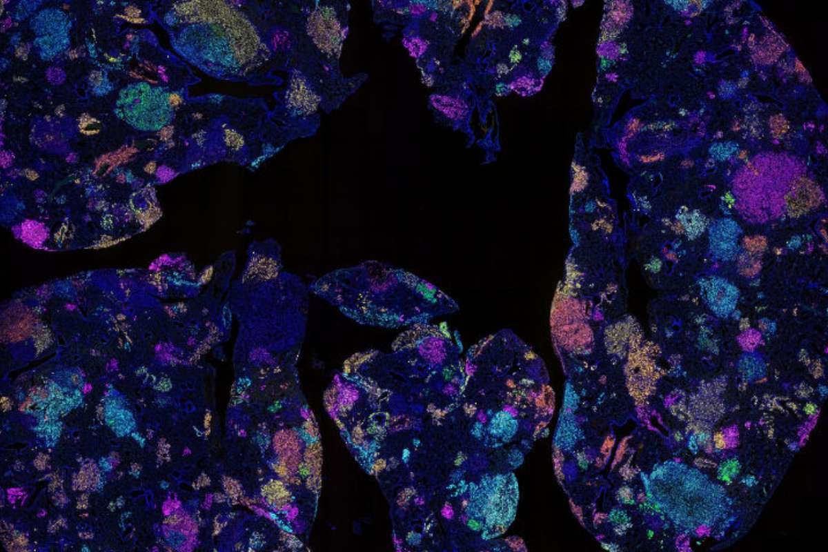 14-Protein Blood Signature Predicts Lung Cancer Risk Early | The Lifesciences Magazine
