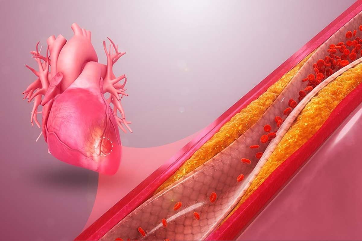 Coronary Artery Disease: Early Signs, Causes & Prevention Guide | The Lifesciences Magazine