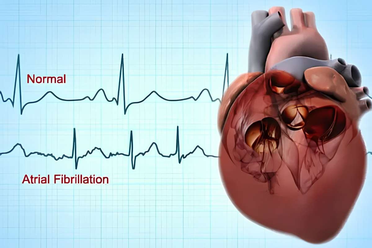 Atrial Fibrillation: Symptoms, Causes, Treatment and Risks | The Lifesciences Magazine
