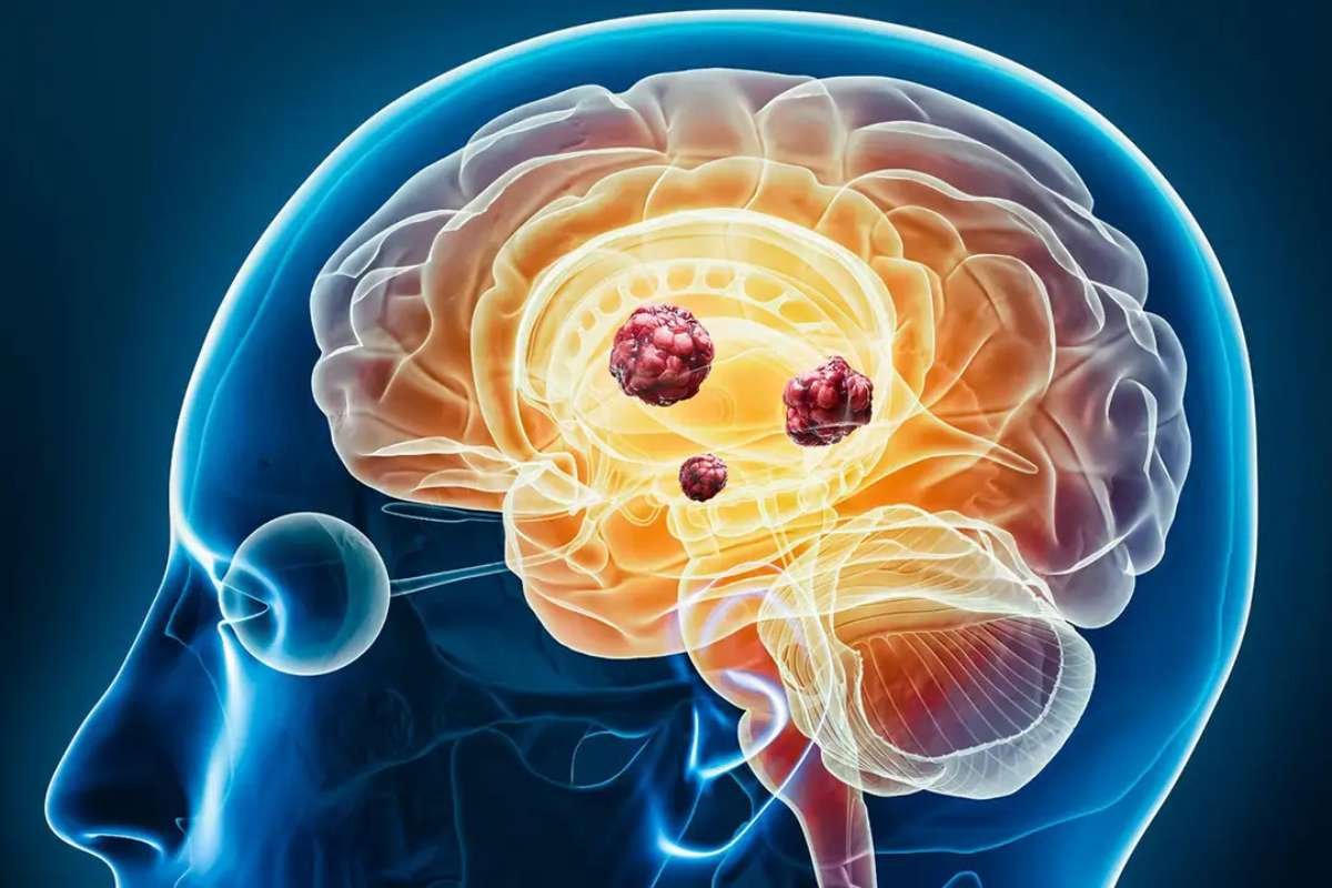 Implanted Radiation Tiles Improve Brain Metastases Survival | The Lifesciences Magazine