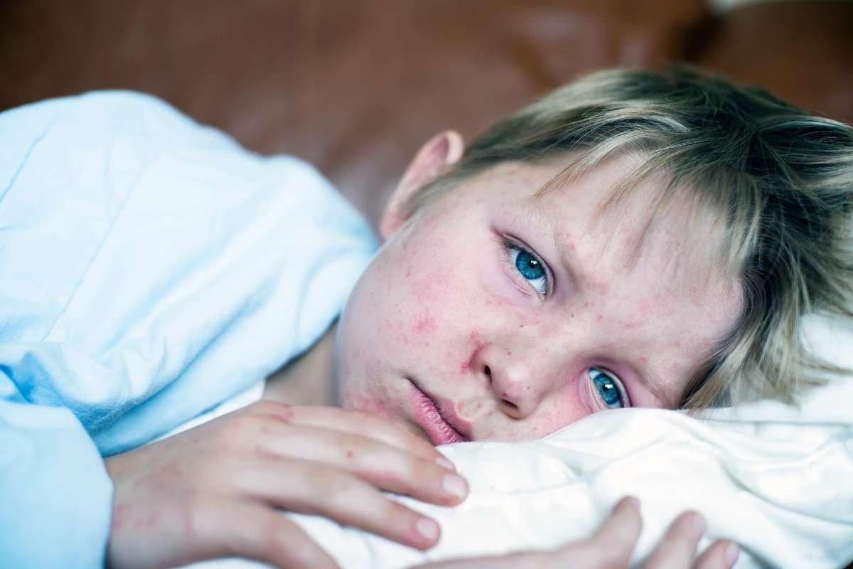 U.S. Measles Cases Reach 35-Year High Amid Utah Outbreak | The Lifesciences Magazine