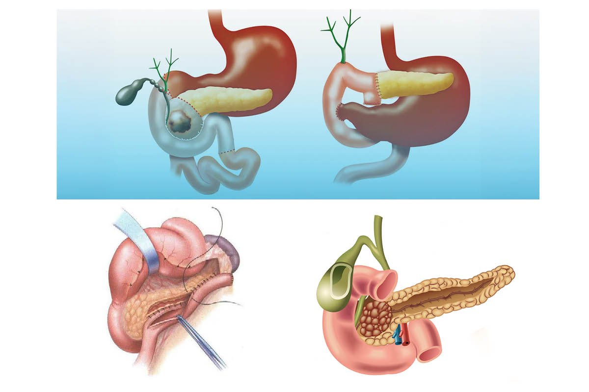 Complex Pancreatic Surgery: Why Experience & Precision Matter | The Lifesciences Magazine