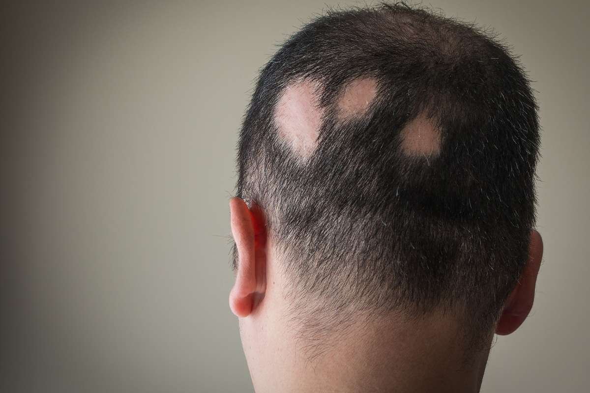 Upadacitinib Shows Strong Hair Regrowth in Alopecia Areata | The Lifesciences Magazine