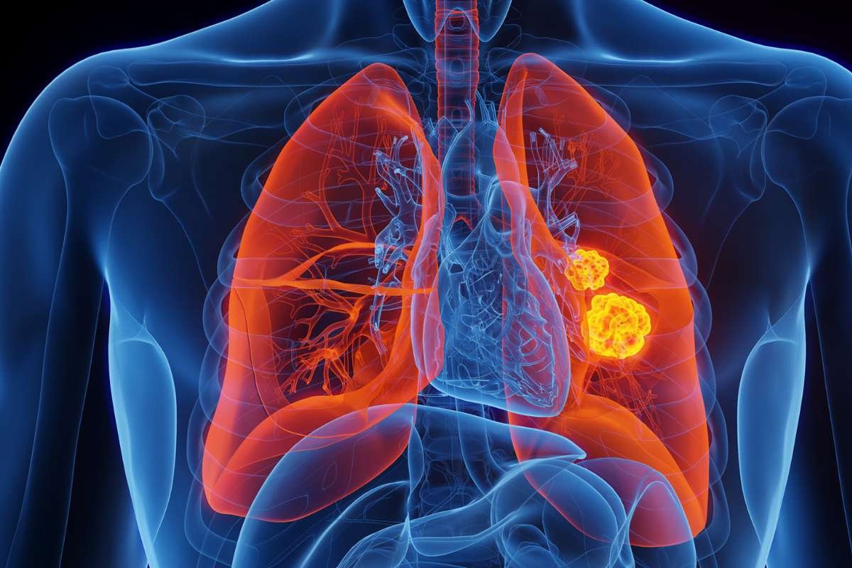 Lung Cancer Risk in Nonsmokers: Genetic Mutation Study | The Lifesciences Magazine