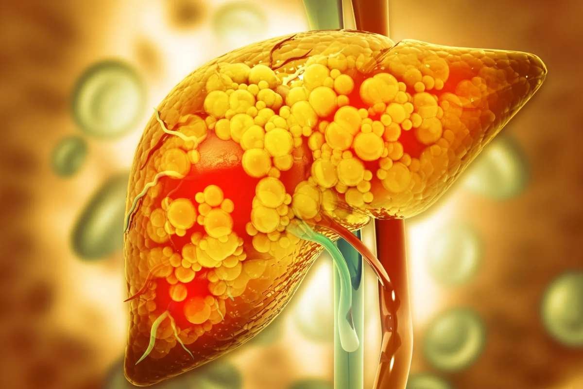 Keto Diet Cuts Liver Fat by 67% in Prediabetes Trial | The Lifesciences Magazine