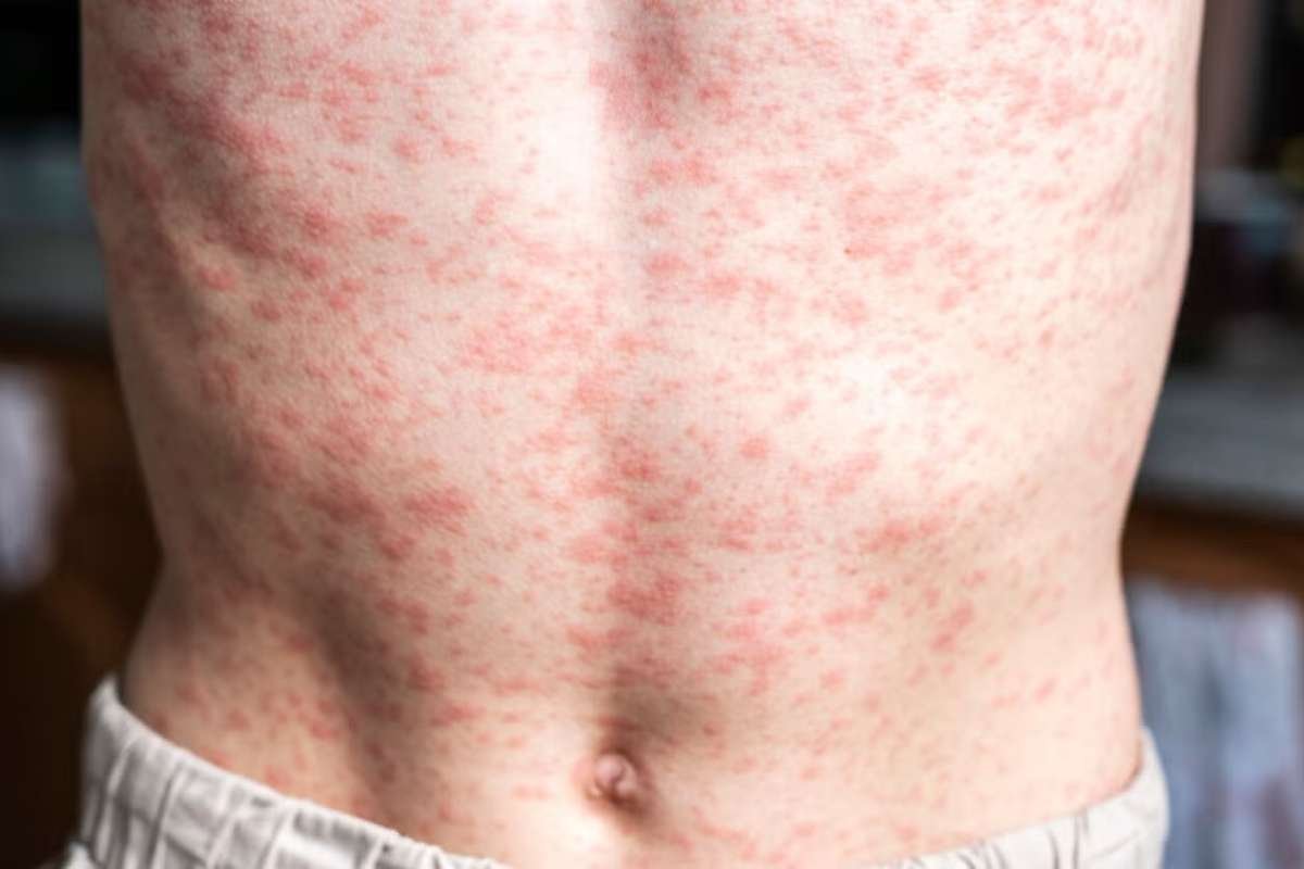 Oregon Measles Cases Reach 50 in 2026: What to Know | The Lifesciences Magazine
