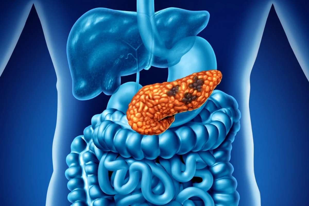 Two Pancreatic Cancers Develop Within One Year | The Lifesciences Magazine