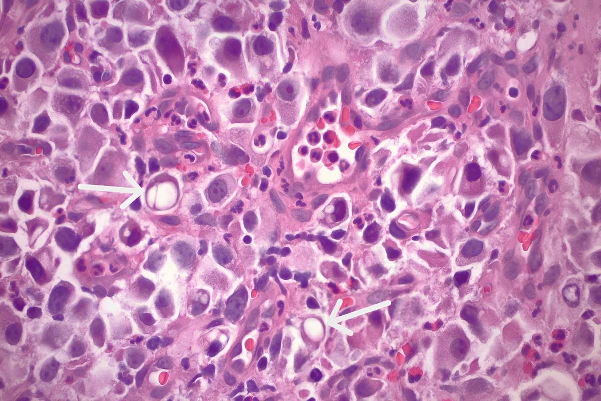 Leptomeningeal Metastasis Causes Sudden Vision Loss | The Lifesciences Magazine