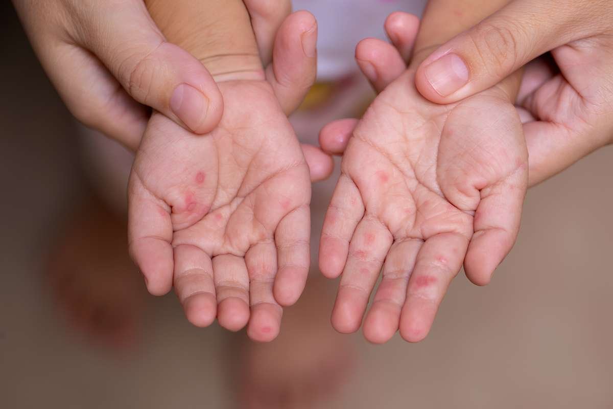 Wisconsin Reports New Measles Case in Chippewa County | The Lifesciences Magazine