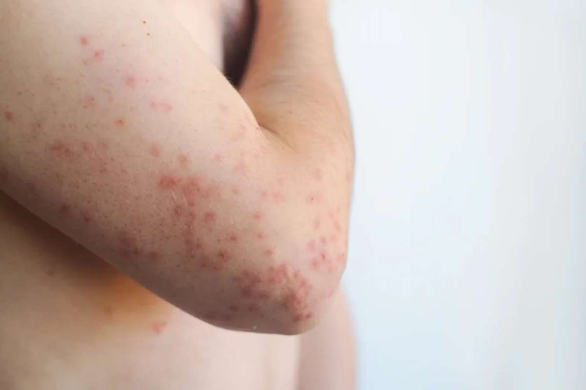 Pennsylvania Measles Cases Reach 943 After Fifth Death | The Lifesciences Magazine